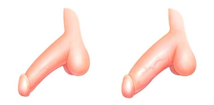 Membre avant et après augmenter